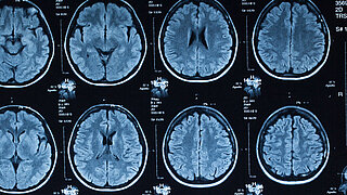 CT Aufnahmen eines menschlichen Gehirns 