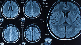 CT Aufnahmen eines menschlichen Gehirns 